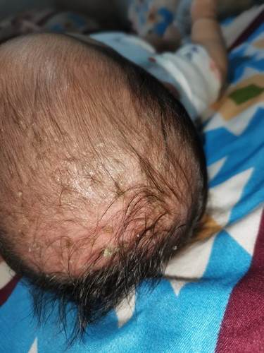 Cradle cap