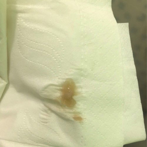 มูกรือตกขาว สอบถามแม่ๆค่ะ