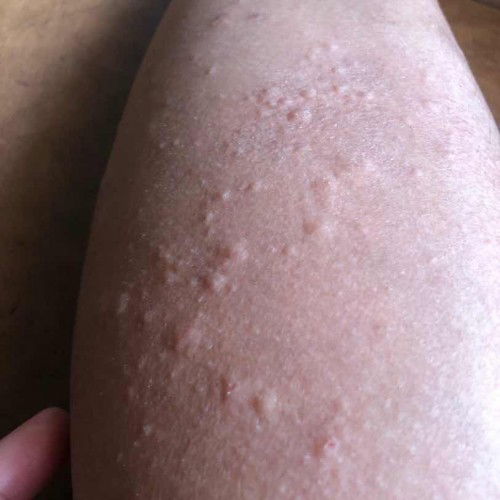 Gatal gatal trimester tiga