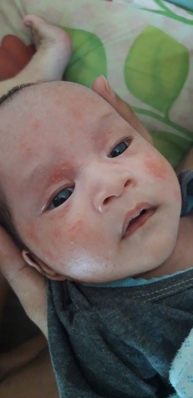 Bintik merah di area wajah