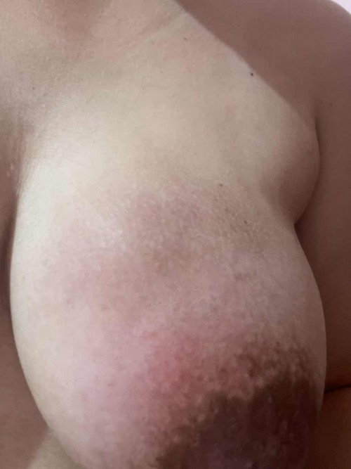 Breast abscess