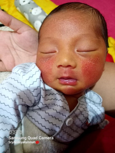 Bayi saya umur 10 hari tiba2 udah mncul kmerahan di wjah nya sma bintik2 putih, kira2 apa y obat nya