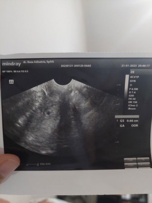 Hasil usg hpht 10des harusnya 6 week