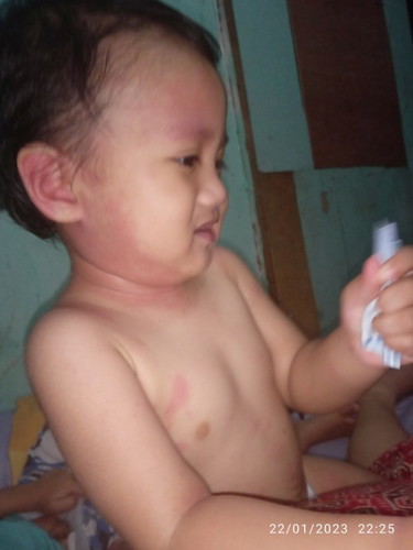 Timbul bintik merah gatal tiba2