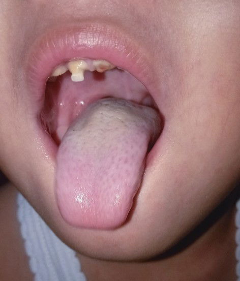 Lidah anak 4 tahun putih