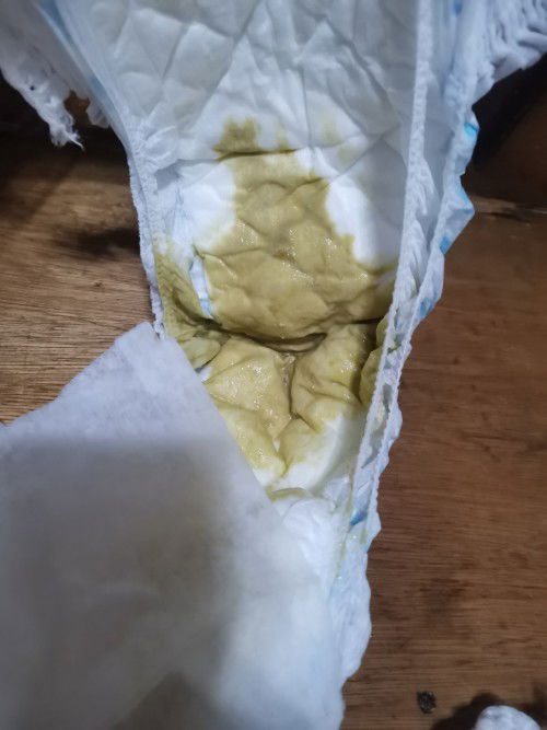 Kakapalit lang po namin kahapon ng pedia sure 1-3 years old po at eto poop niya normal lang po bato?