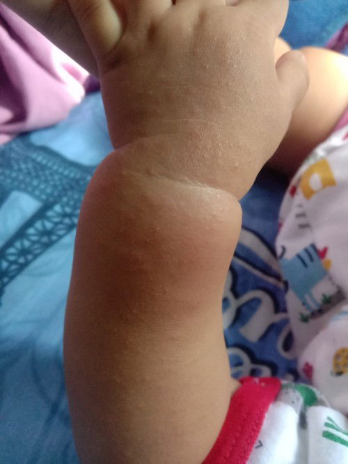 Kulit bayi beruntusan