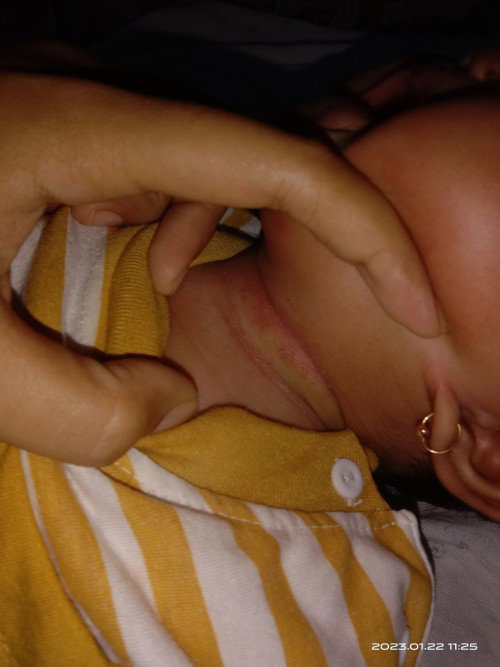Biang keringat pada bayi