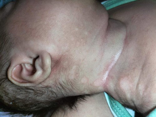 Skin Rashes