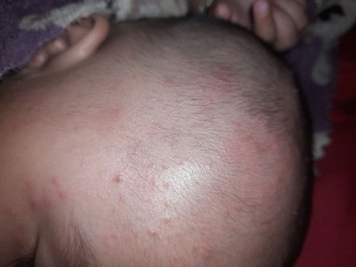 Kasih tips dong bun,obat untuk menyembuhkan ini