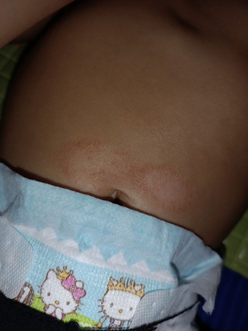 Ruam pada perut bayi
