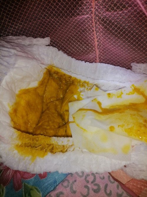 ขอสอบถามแม่ๆหน่อยค่ะลูกถ่ายเป็นมูกแต่ไม่มีเลือดจะต้องไปหาหมอไหมค่ะน้อง3เดือนกินนมแม่ล้วนค่ะ