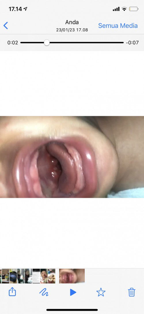 Rahang bayi newborn seperti sariawan