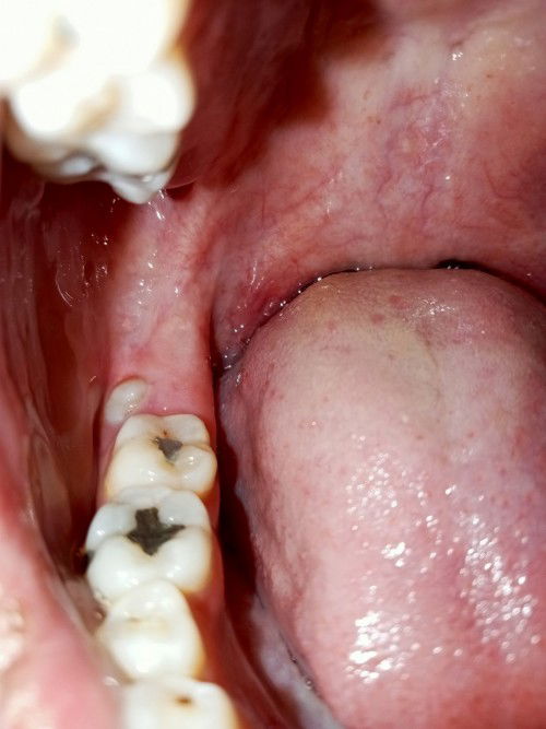 ฟันคุดขึ้น