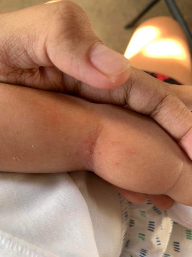 hello mga mi ask ko lang po ano pwede sa baby kapag ang baby is allergy sa Manzanilla?