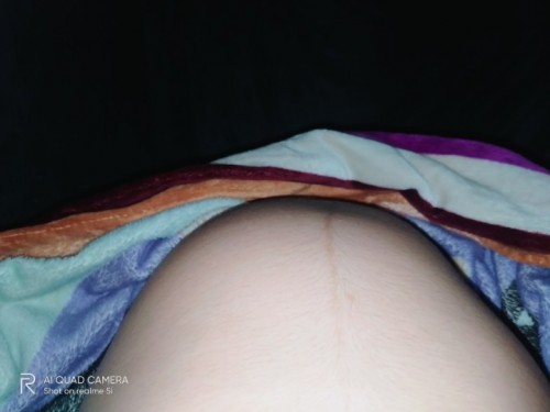 แบบนี้ลูกโก่งตัวหรือท้องแข็งค่ะ
พอดีนอนตะแคงละหันมามันนูนปูดแบบนี้เลย 37weeks 3day