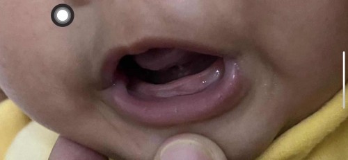แบบนี้ฟันน้องจะขึ้นรึเปล่าคะ