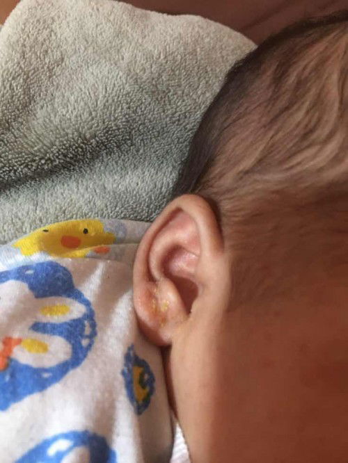 ผื่นทารกแบบนี้ คือผื่นอะไรค่ะ