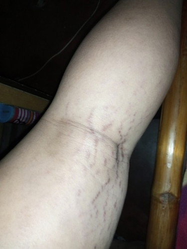 35weeks pregnant here, after ko po bang manganak may chance pa bang matanggal tong Stretch marks?