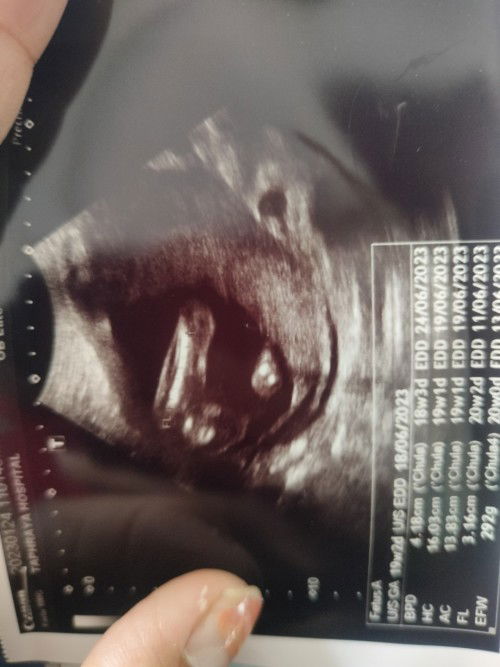 แบบนี้ใช้ใบเพศลูกไหมค่ะ ถ้าใช่ช่วยดูหน่อยค่ะ ว่าผู้หญิงหรือผู้ชาย