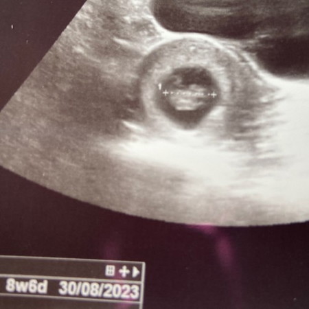 Esok dah 9 weeks😭🥰