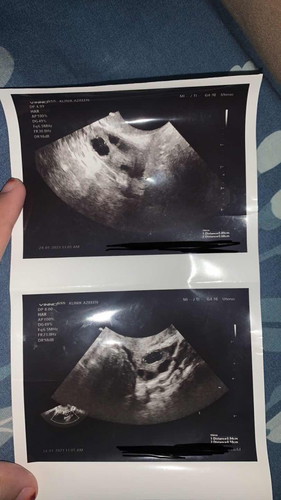TVS scan. Size telur kecik, pcos?