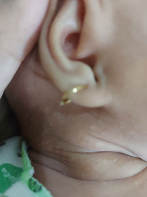 bintik putih kayak panu di leher bayi