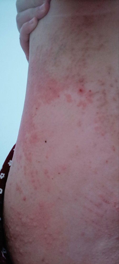 Gatal gatal trimester 2