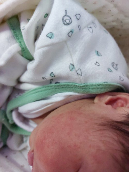 Normal lang po ba yung sa face ng baby ko? Turning 1 month old palang po siya sa 30.