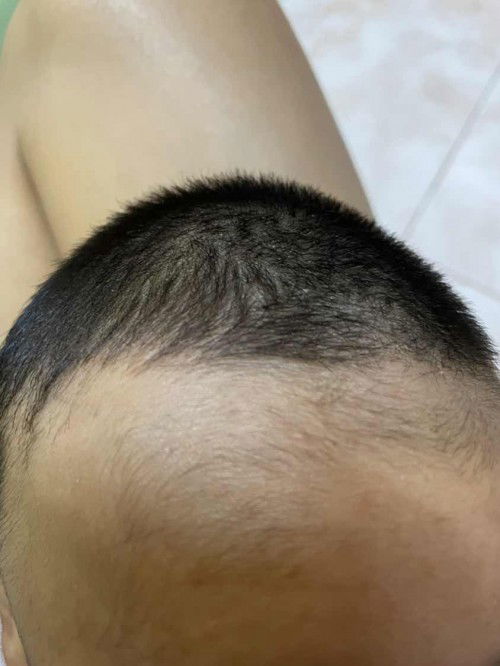 ลูกหนังศีรษะแห้ง