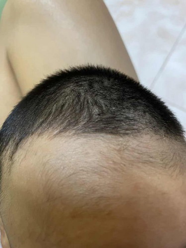 ลูกหนังศีรษะแห้ง