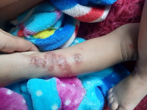 Các mom cho em hỏi bé E bị như  này là bệnh gì ạ. Bé bị ngứa gãi suốt nên lan  ra.  Trên đầu cũng bị