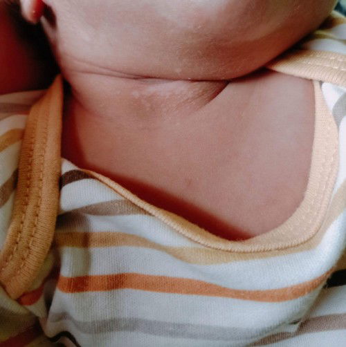 Good day po mga mommies, ask lang po, delikado ba ito white spot2 na tumubo sa leeg ni baby po?