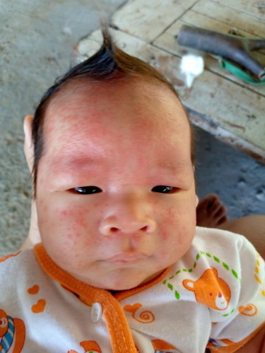ลูกผดผื่นขึ้นทำไงดีค้ะ