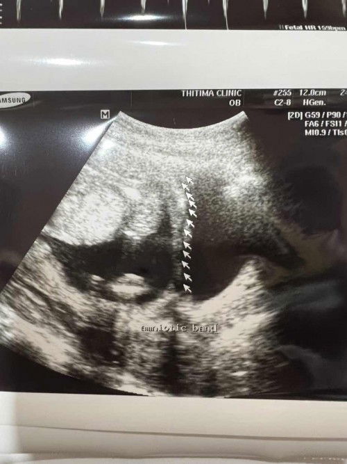 Amniotic band ผังผืดในถุงน้ำคร่ำ