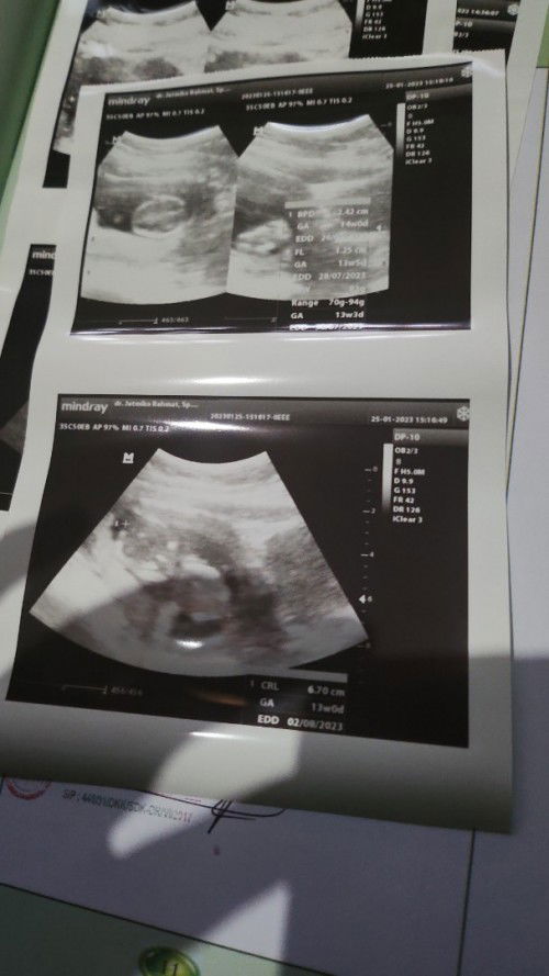 Ukuran normal janin berapa sih mom?