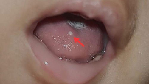 Benjolan putih di lidah