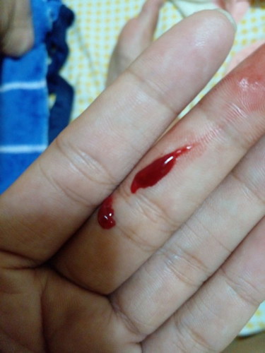 เลือดออกอันตรายไหม