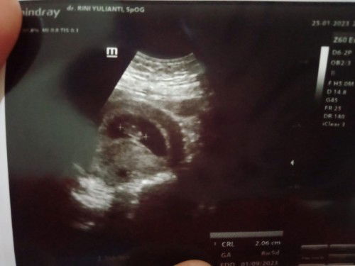 Hasil USG sudah terlihat