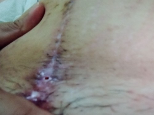 sasara po b kusa ung butas ng tahi via cs nagkabutas po kasi sakin pa suggest nman po..tia