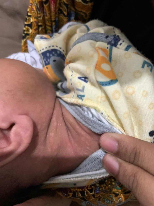 Bercaak putih pada leher bayi