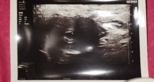 klo begini bru kantung ato sdh ada janin ya mom?