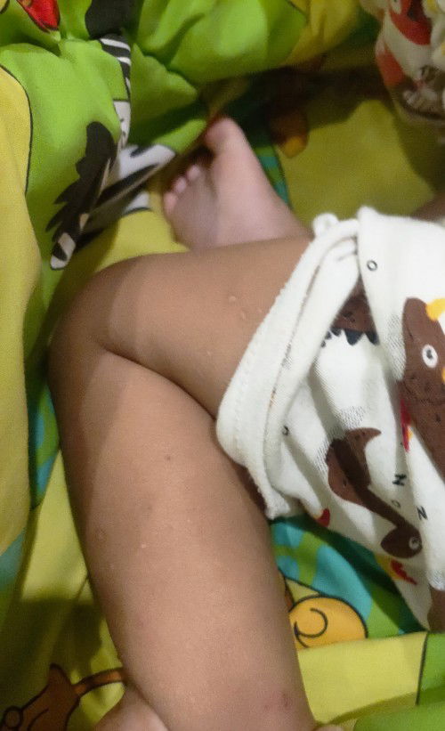 ช่วยแนะนำผลิตภัณฑ์ลดอาการตุ้มคัน