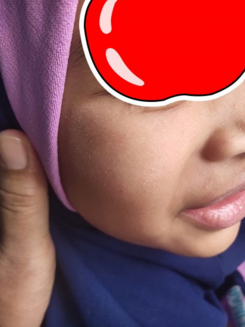 Bunda ada yg sama anak bgni sdh diksh salep cinicolon N/myco z/dokter umum blm sembuh,ada solusi???