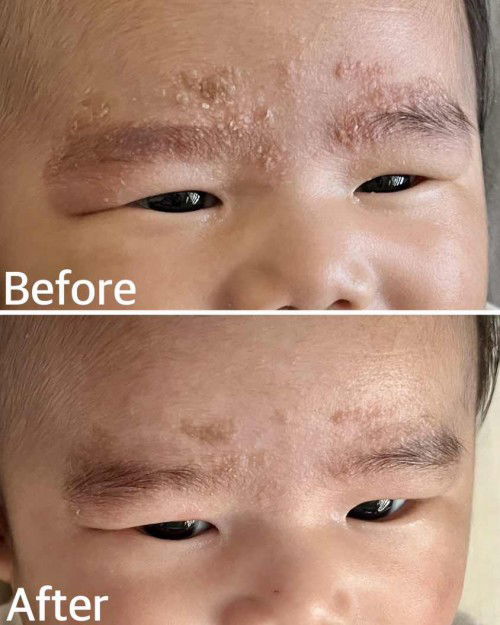 Cradle Cap Solution