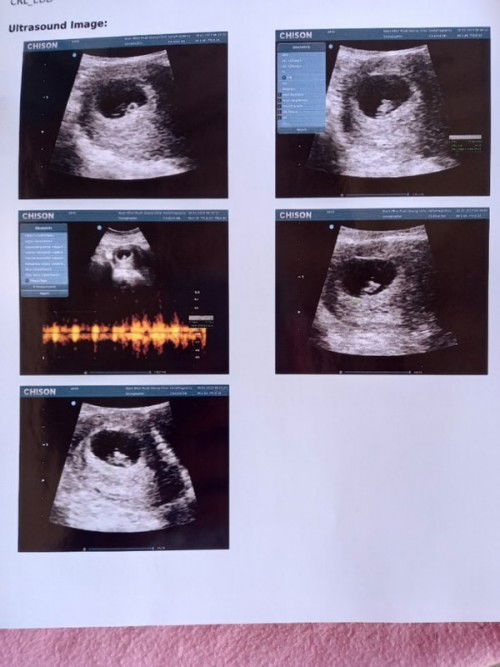 จากผู้ป่วยมีบุตรยากสู่คุณแม่ท้องที่4ในวันนี้🥰