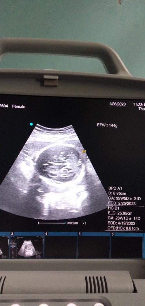 Hasil usg 28w BPD 8,85cm itu normal ga ya bun?