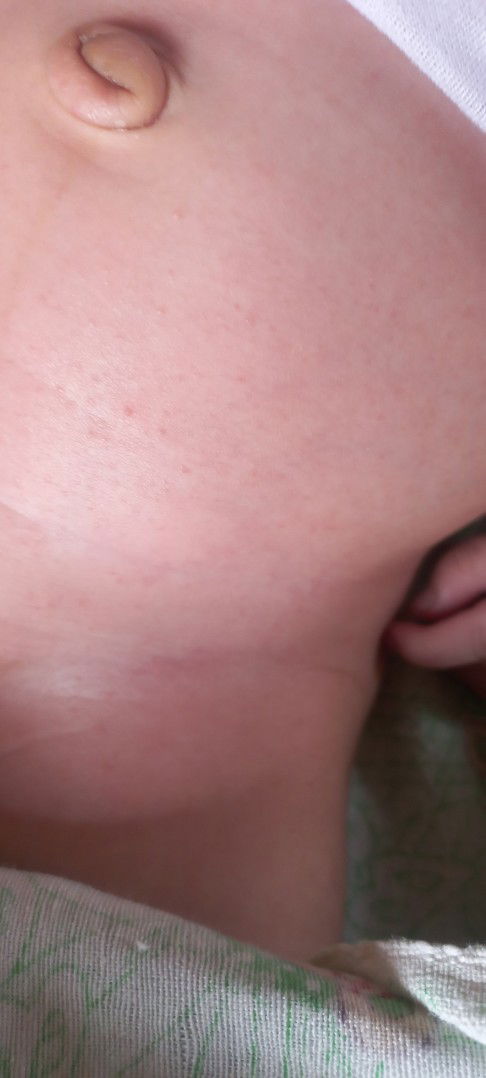 Bintik merah pada bayi 1 bulan