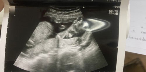 ตั้งครรภ์ได้21w น้องหนีบขาไว้