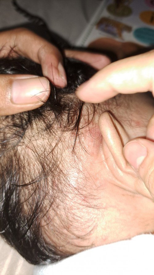 awalnya bayi tidak menunjukkan tanda2 alergi apapun sejak konsumsi sufor bebel*ve namun